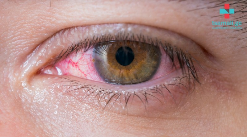 გლაუკომა - თვალის მულტიფაქტორული ქრონიკული დაავადება 