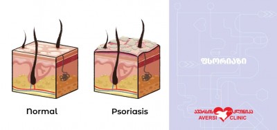 რა უნდა ვიცოდეთ ფსორიაზის შესახებ